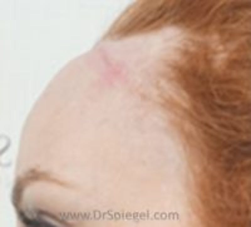 Browlift / Fox Eye Lift Before & After Gallery - Patient 254513 - Image 2