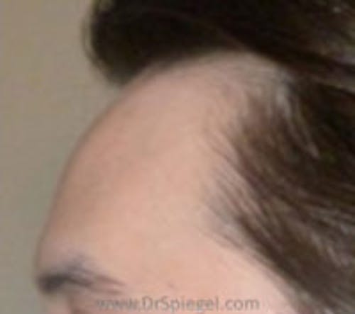 Brow Lift / Fox Eye Lift Before & After Gallery - Patient 424932 - Image 1