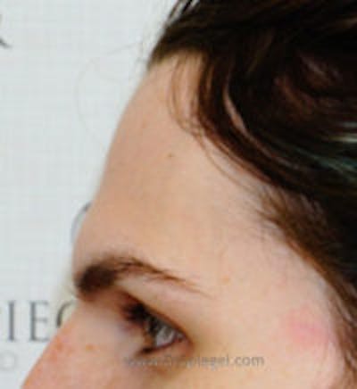Browlift / Fox Eye Lift Before & After Gallery - Patient 347771 - Image 1