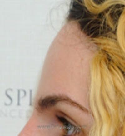 Browlift / Fox Eye Lift Before & After Gallery - Patient 347771 - Image 2