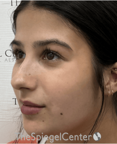 Buccal Fat Reduction Before & After Gallery - Patient 411408 - Image 3