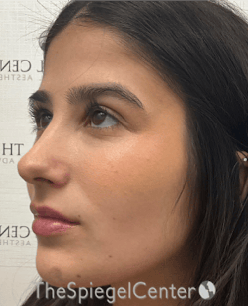 Buccal Fat Reduction Before & After Gallery - Patient 411408 - Image 4