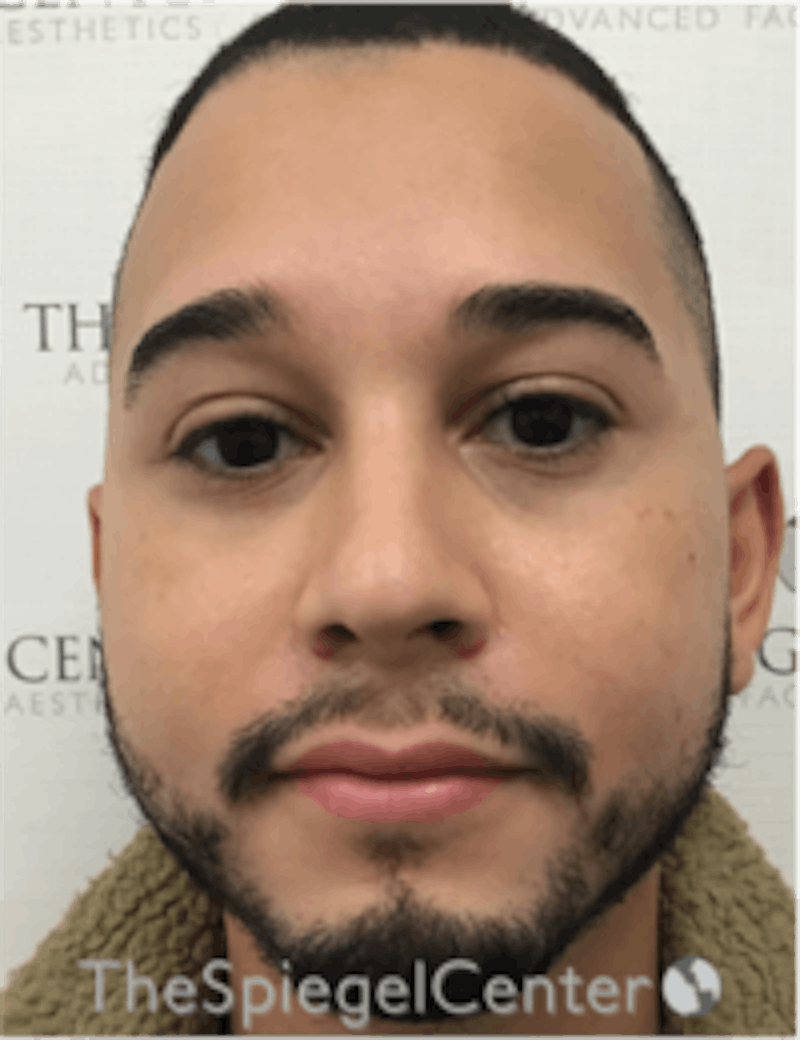 Buccal Fat Reduction Before & After Gallery - Patient 378761 - Image 1