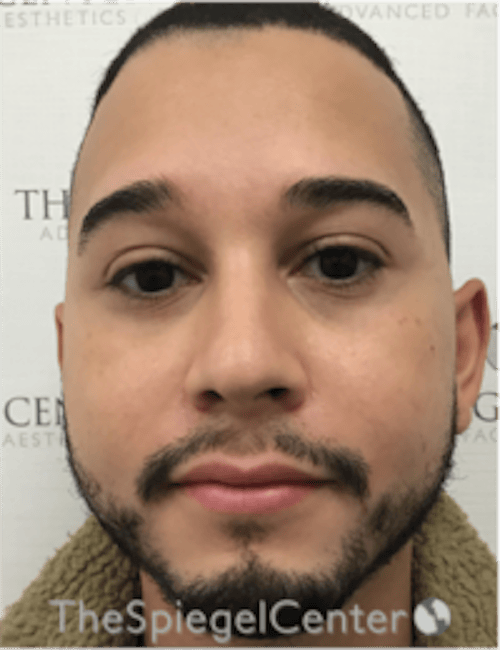 Buccal Fat Reduction Before & After Gallery - Patient 378761 - Image 1
