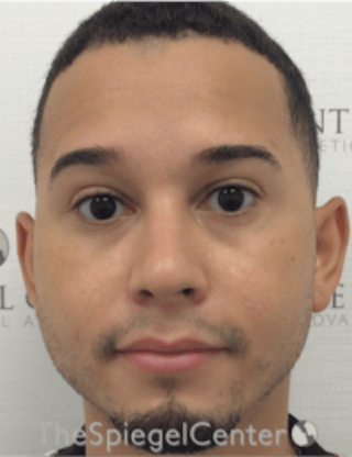 Buccal Fat Reduction Before & After Gallery - Patient 378761 - Image 2