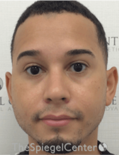 Buccal Fat Reduction Before & After Gallery - Patient 378761 - Image 2