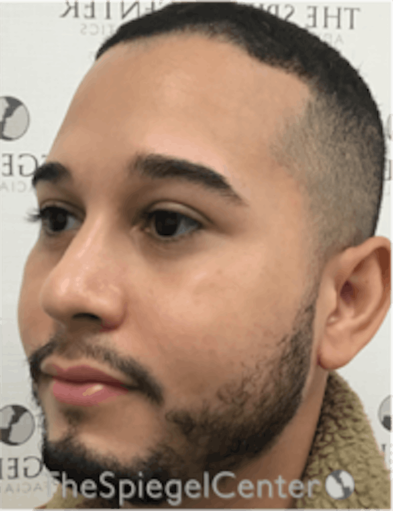 Buccal Fat Reduction Before & After Gallery - Patient 378761 - Image 3