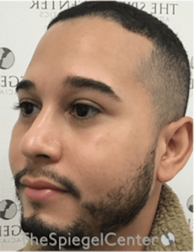 Buccal Fat Reduction Before & After Gallery - Patient 378761 - Image 3