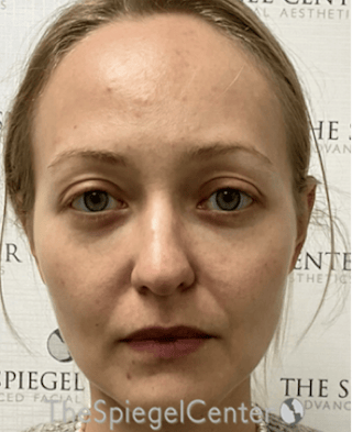 Buccal Fat Reduction Before & After Gallery - Patient 299914 - Image 2