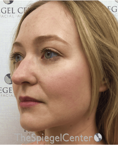 Buccal Fat Reduction Before & After Gallery - Patient 299914 - Image 3