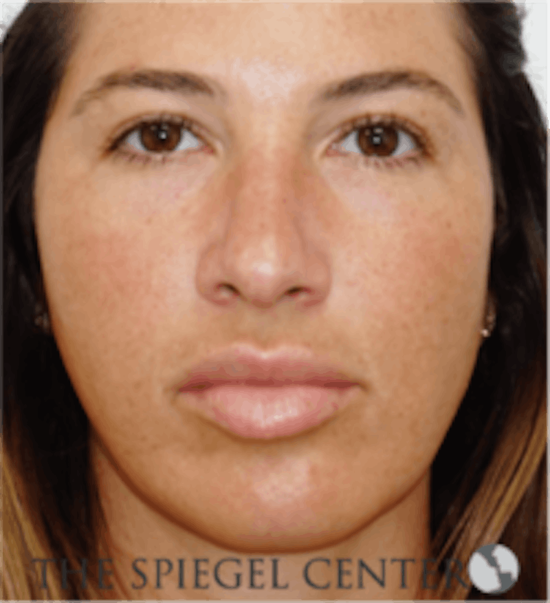 Buccal Fat Reduction Before & After Gallery - Patient 360987 - Image 1