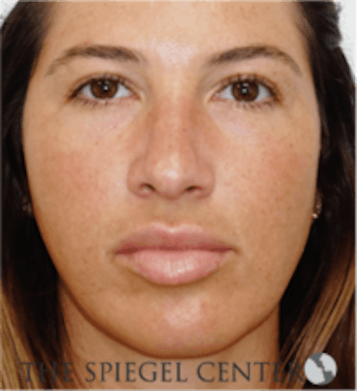 Buccal Fat Reduction Before & After Gallery - Patient 360987 - Image 1