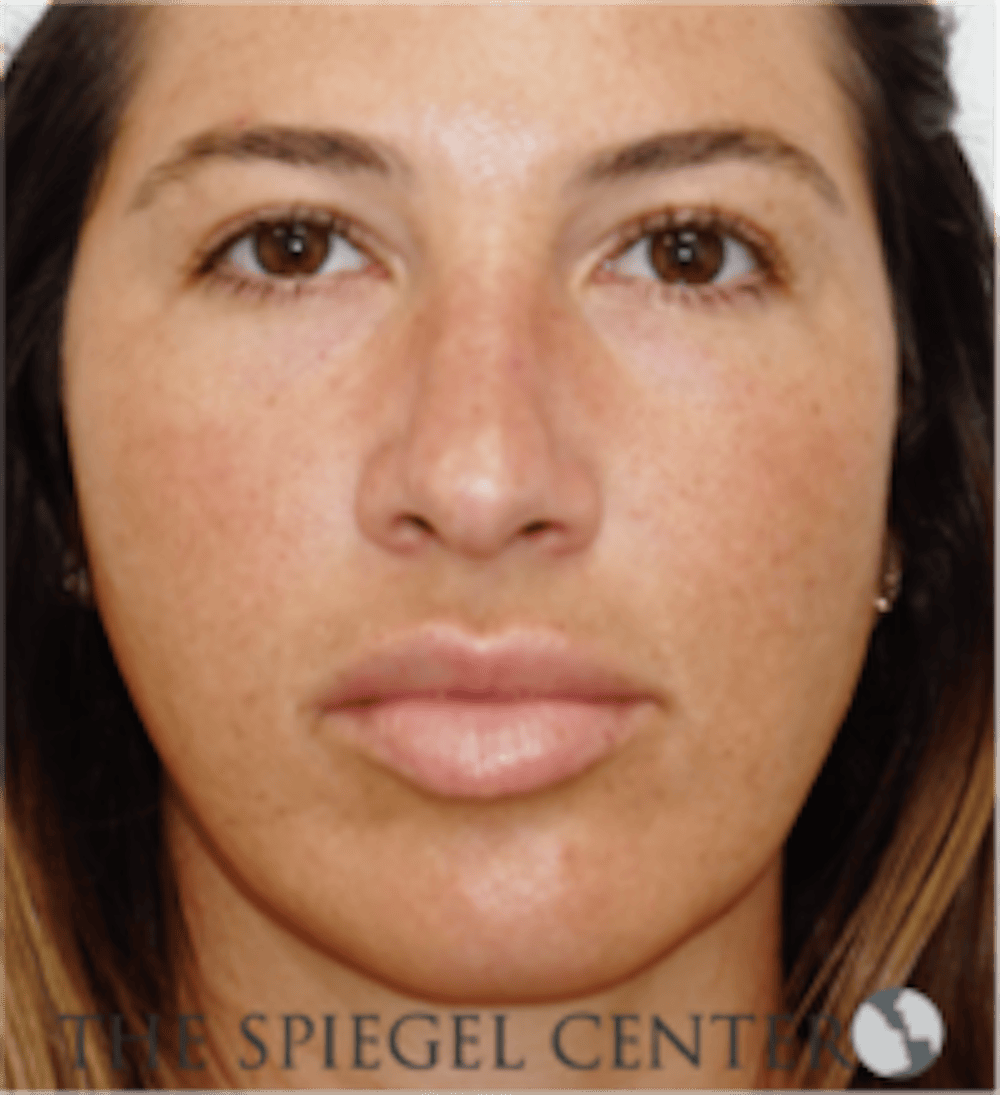 Buccal Fat Removal