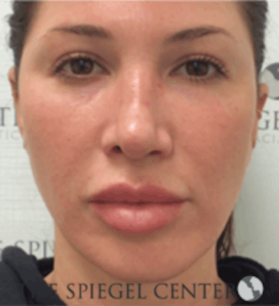 Buccal Fat Reduction Before & After Gallery - Patient 360987 - Image 2