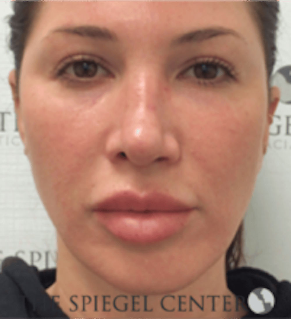 Buccal Fat Removal