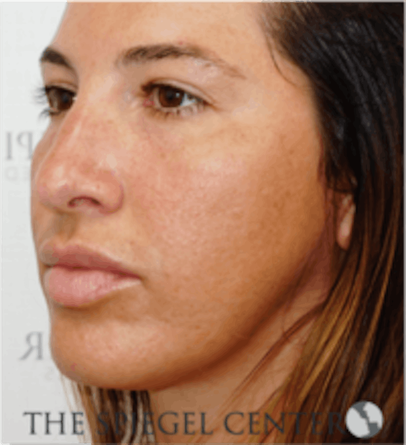 Buccal Fat Reduction Before & After Gallery - Patient 360987 - Image 3