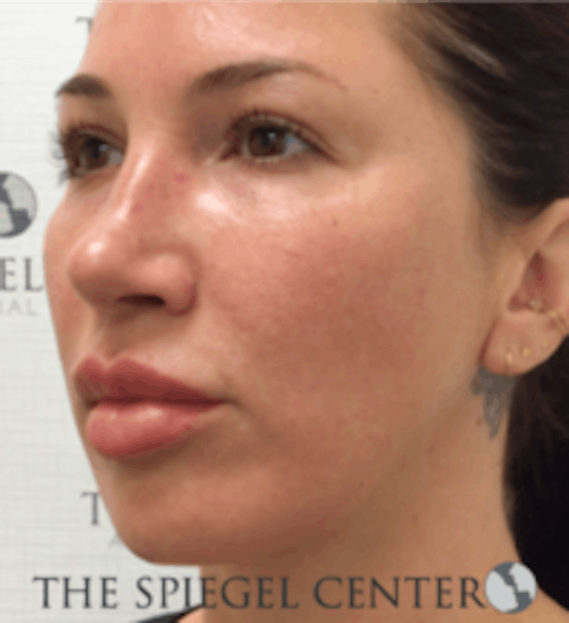 Buccal Fat Reduction Before & After Gallery - Patient 360987 - Image 4