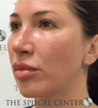 Buccal Fat Reduction Before & After Gallery - Patient 360987 - Image 4