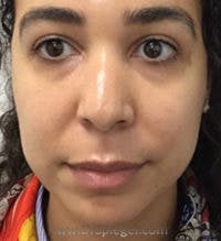 Buccal Fat Reduction Before & After Gallery - Patient 227603 - Image 1