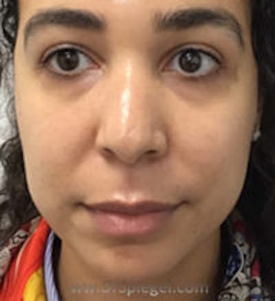 Buccal Fat Reduction Before & After Gallery - Patient 227603 - Image 1