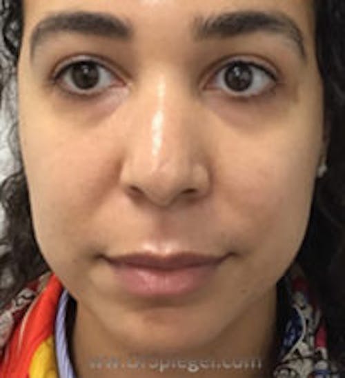 Buccal Fat Reduction Before & After Gallery - Patient 227603 - Image 1