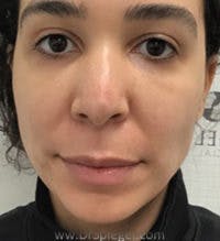 Buccal Fat Reduction Before & After Gallery - Patient 227603 - Image 2