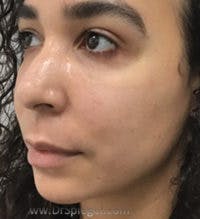 Buccal Fat Reduction Before & After Gallery - Patient 227603 - Image 3