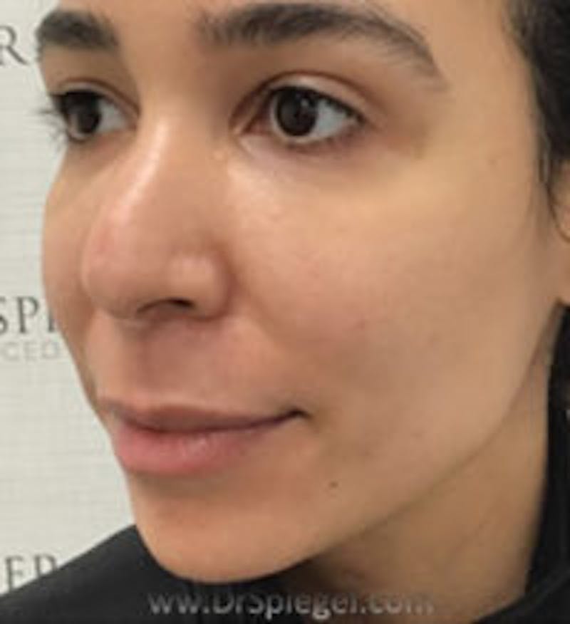 Buccal Fat Reduction Before & After Gallery - Patient 227603 - Image 4