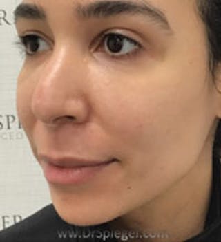 Buccal Fat Reduction Before & After Gallery - Patient 227603 - Image 4