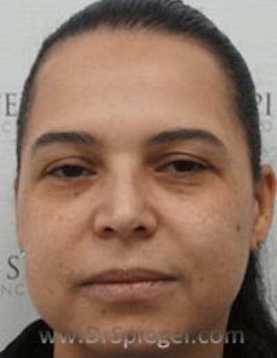 Buccal Fat Reduction Before & After Gallery - Patient 246878 - Image 1