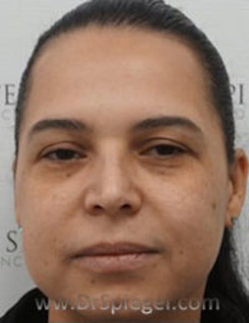 Buccal Fat Reduction Before & After Gallery - Patient 246878 - Image 1