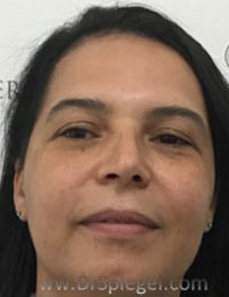 Buccal Fat Reduction Before & After Gallery - Patient 246878 - Image 2