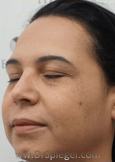 Buccal Fat Reduction Before & After Gallery - Patient 246878 - Image 3