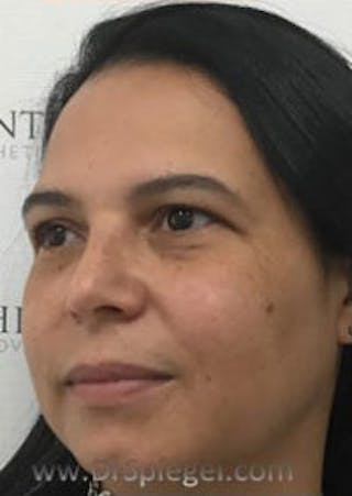 Buccal Fat Reduction Before & After Gallery - Patient 246878 - Image 4