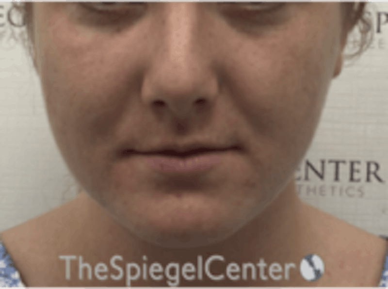 Buccal Fat Reduction Before & After Gallery - Patient 164059 - Image 1