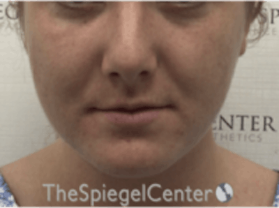Buccal Fat Reduction Before & After Gallery - Patient 164059 - Image 1