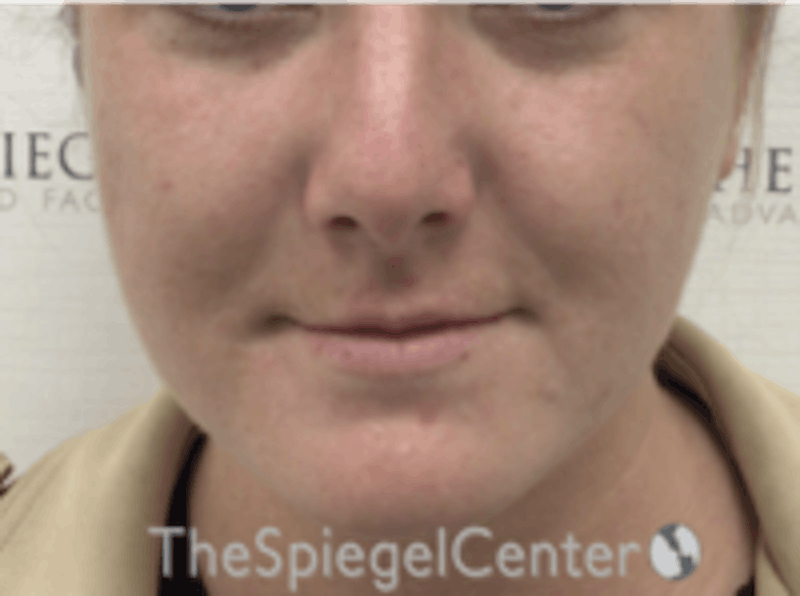 Buccal Fat Reduction Before & After Gallery - Patient 164059 - Image 2