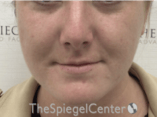 Buccal Fat Reduction Before & After Gallery - Patient 164059 - Image 2
