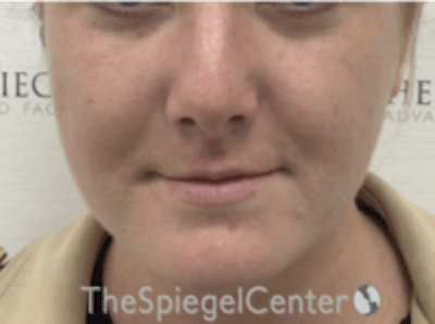 Buccal Fat Reduction Before & After Gallery - Patient 164059 - Image 2