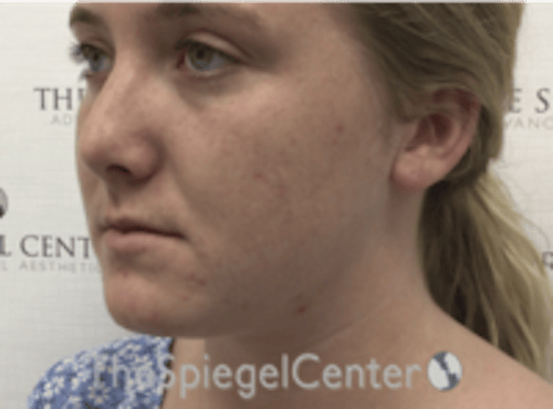 Buccal Fat Reduction Before & After Gallery - Patient 164059 - Image 3