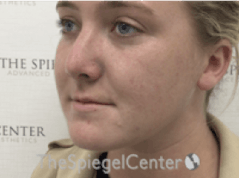 Buccal Fat Reduction Before & After Gallery - Patient 164059 - Image 4