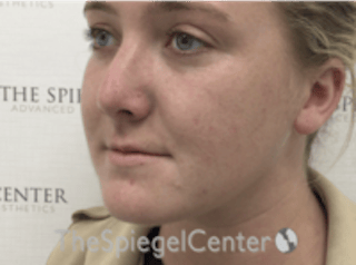 Buccal Fat Reduction Before & After Gallery - Patient 164059 - Image 4