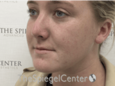 Buccal Fat Reduction Before & After Gallery - Patient 164059 - Image 4
