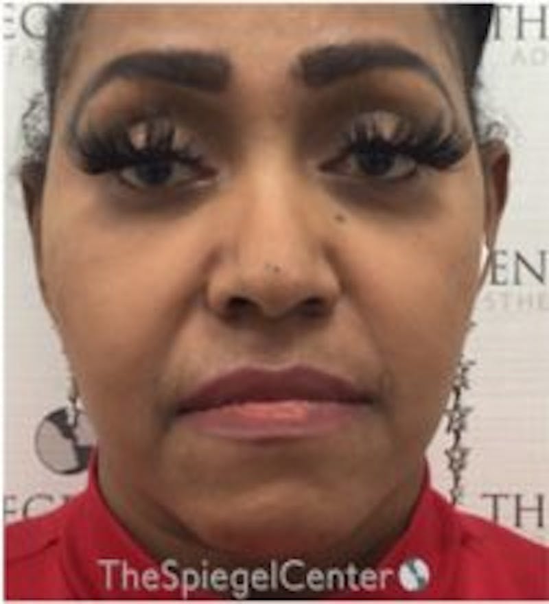 Buccal Fat Reduction Before & After Gallery - Patient 418528 - Image 2