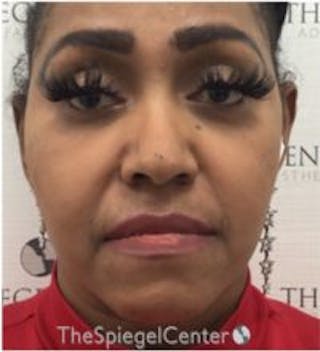 Buccal Fat Reduction Before & After Gallery - Patient 418528 - Image 2