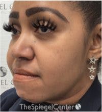 Buccal Fat Reduction Before & After Gallery - Patient 418528 - Image 3