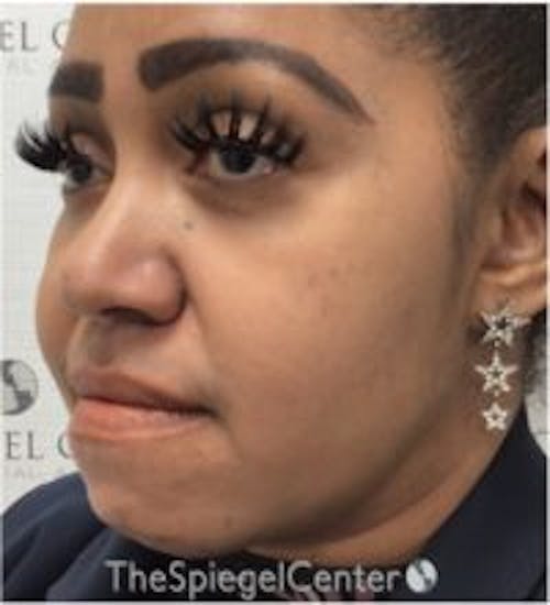 Buccal Fat Reduction Before & After Gallery - Patient 418528 - Image 3