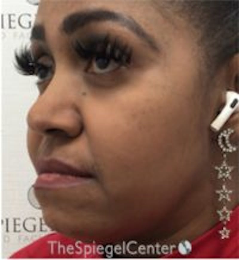 Buccal Fat Reduction Before & After Gallery - Patient 418528 - Image 4