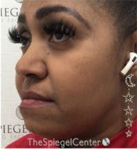 Buccal Fat Reduction Before & After Gallery - Patient 418528 - Image 4