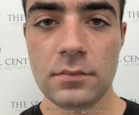 Buccal Fat Reduction Before & After Gallery - Patient 773447 - Image 1